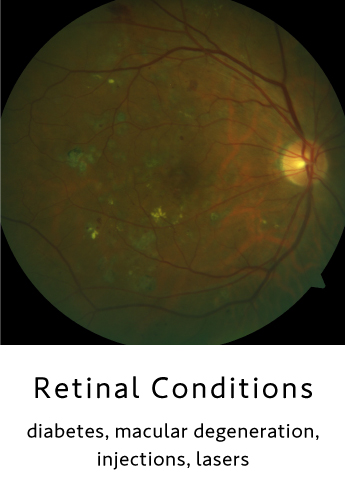 Retinal Conditions